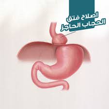 /فتق في الحجاب الحاجز